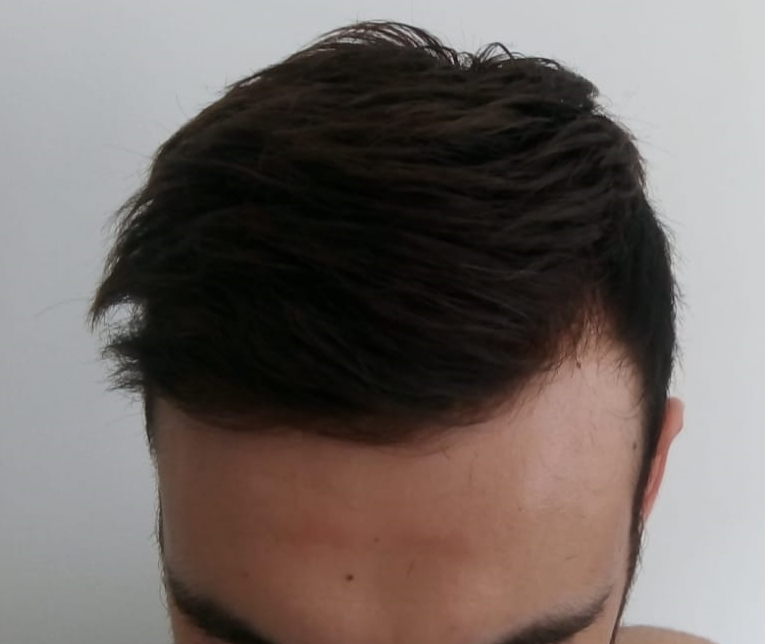 Photo après 1