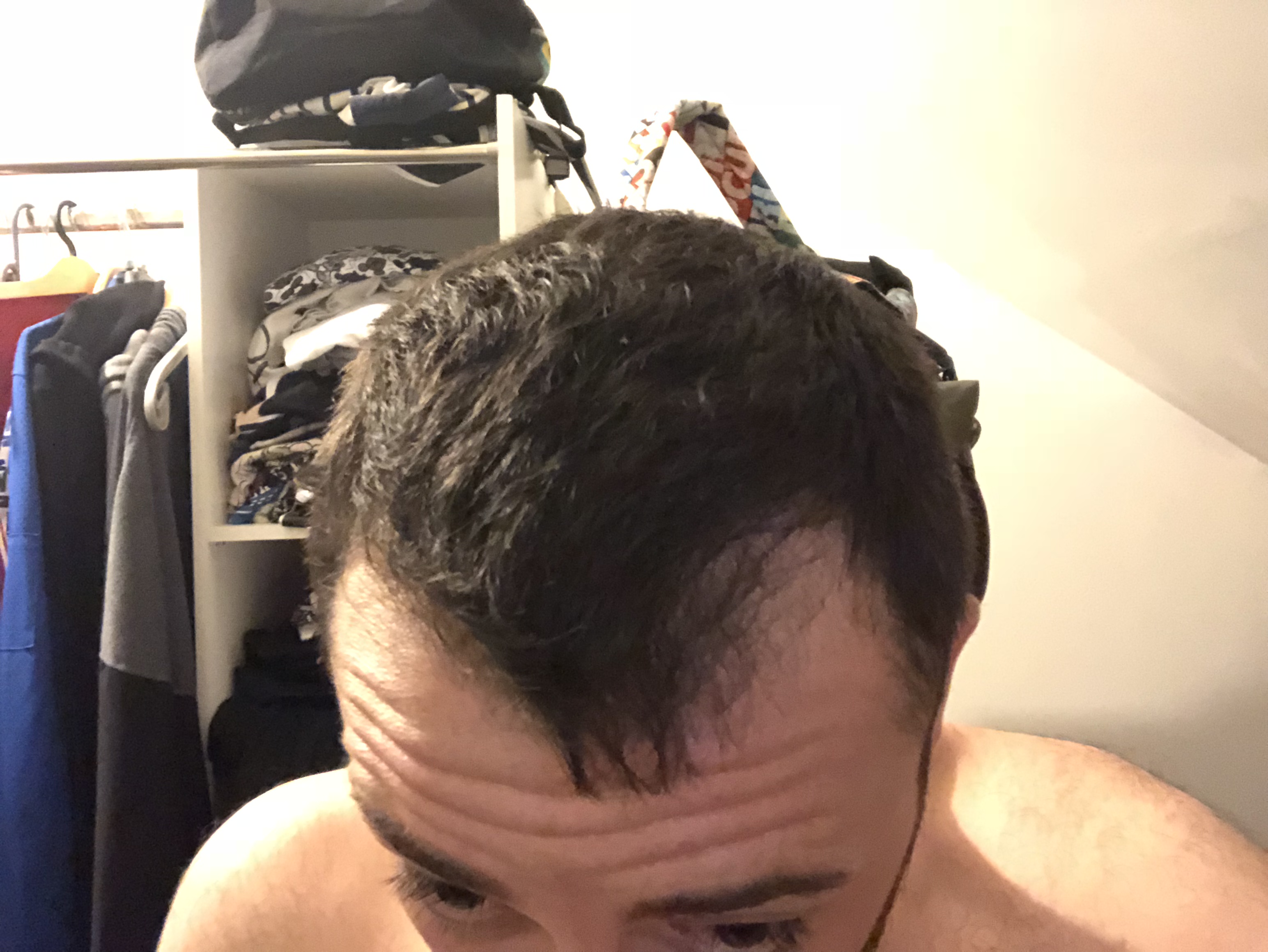 Chute de cheveux homme bordure frontale