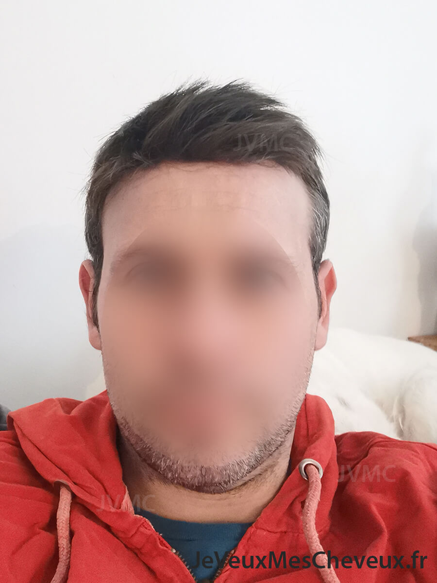 complément capillaire homme brun