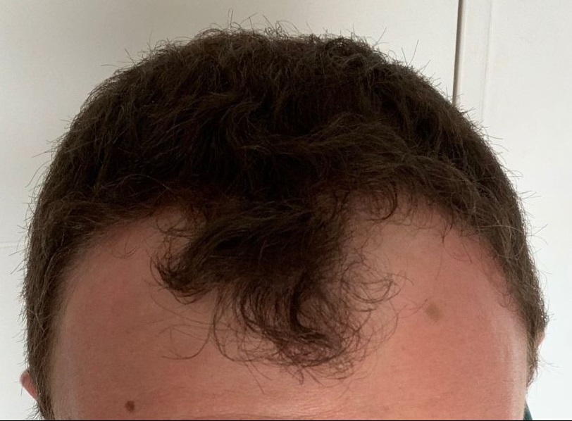 Chute de cheveux homme