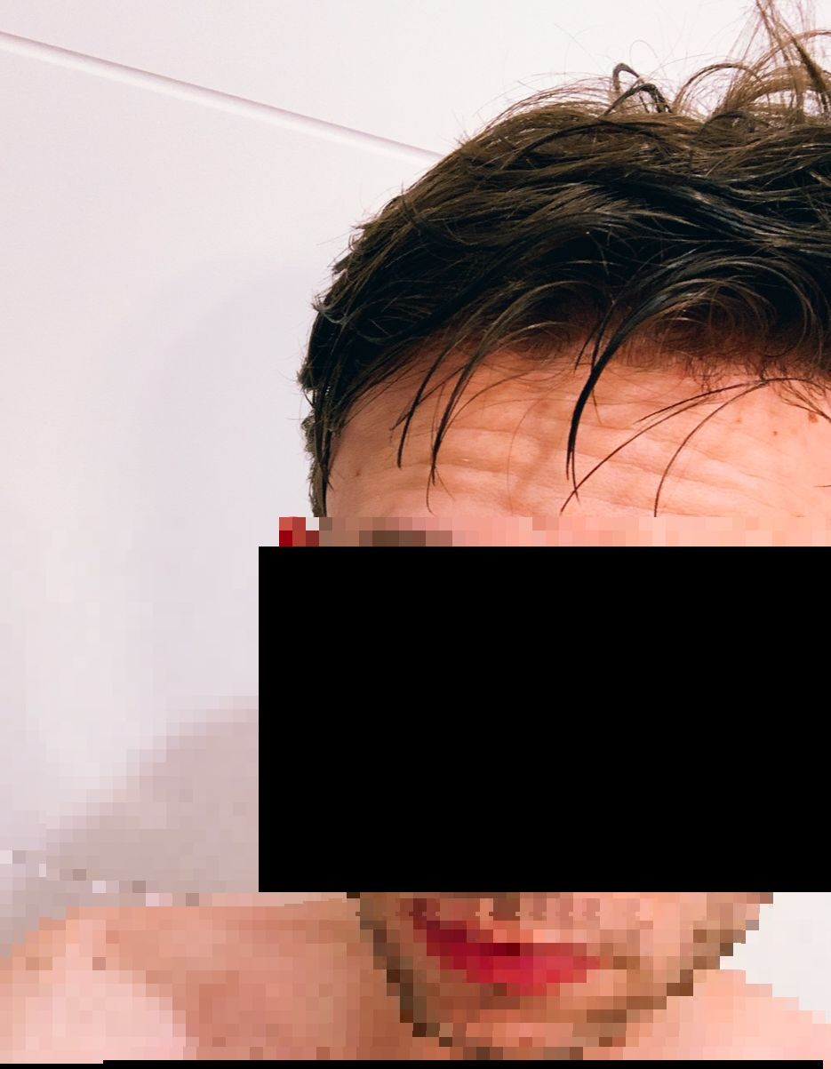 Résultat complément capillaire homme