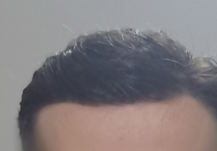 Complément capillaire homme
