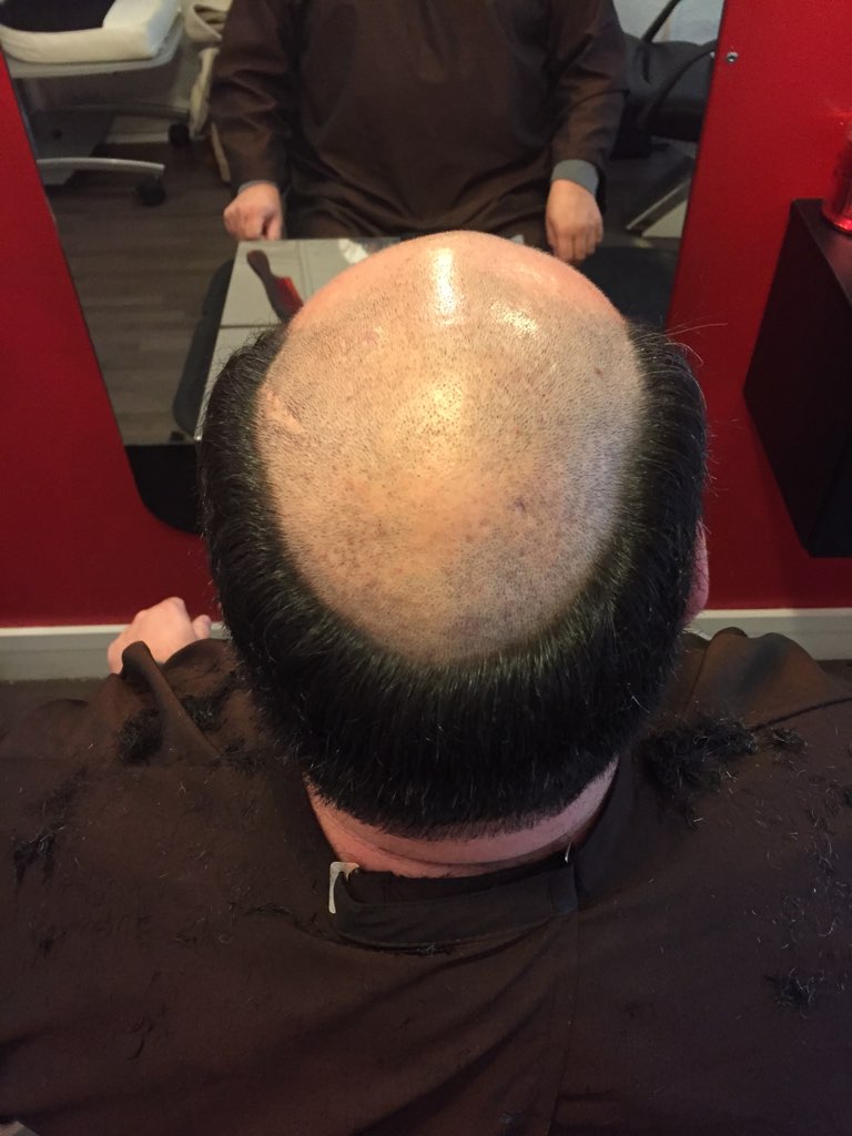 Homme avant complément capillaire