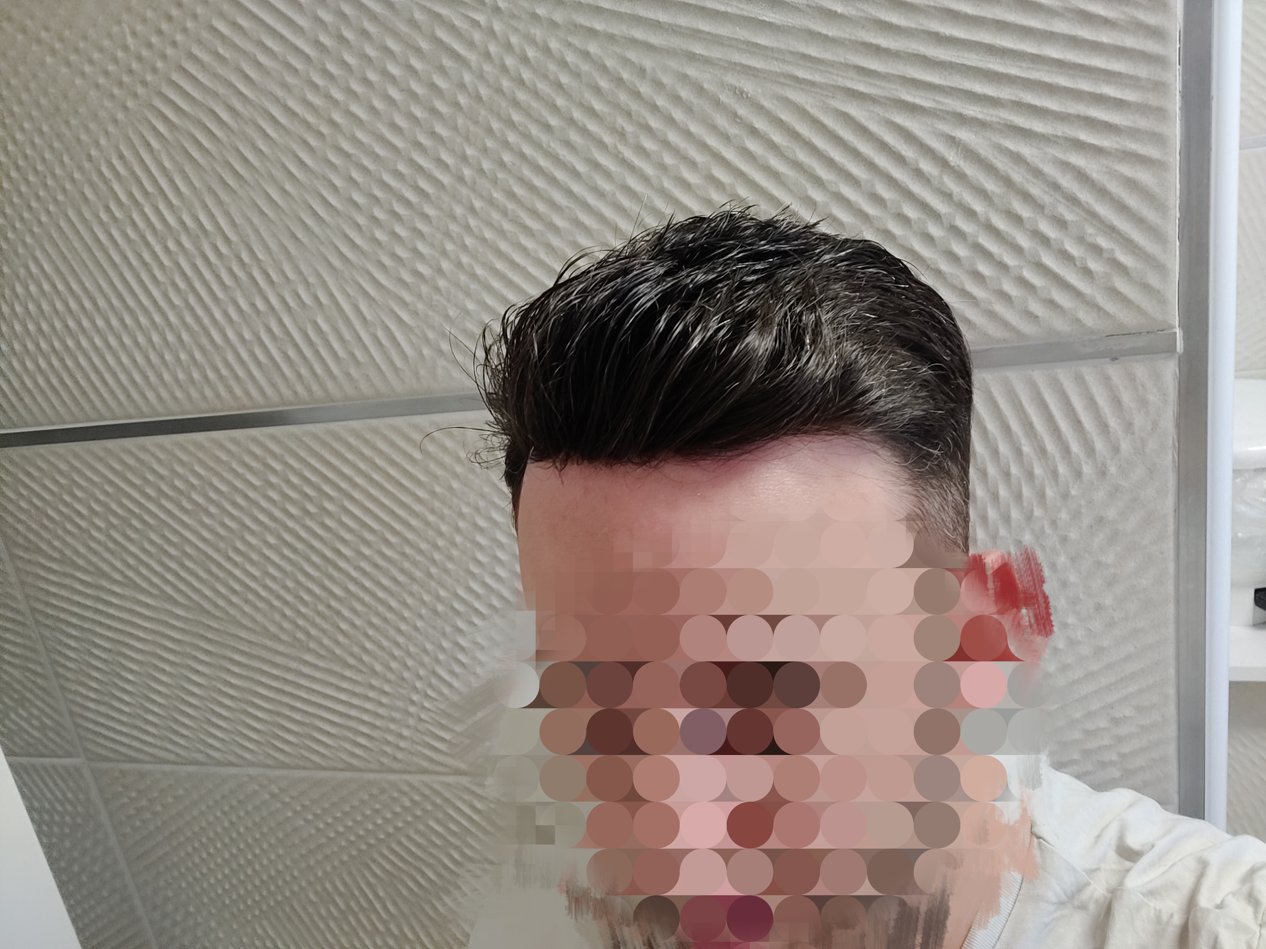 résultat d'un complément capillaire homme de face