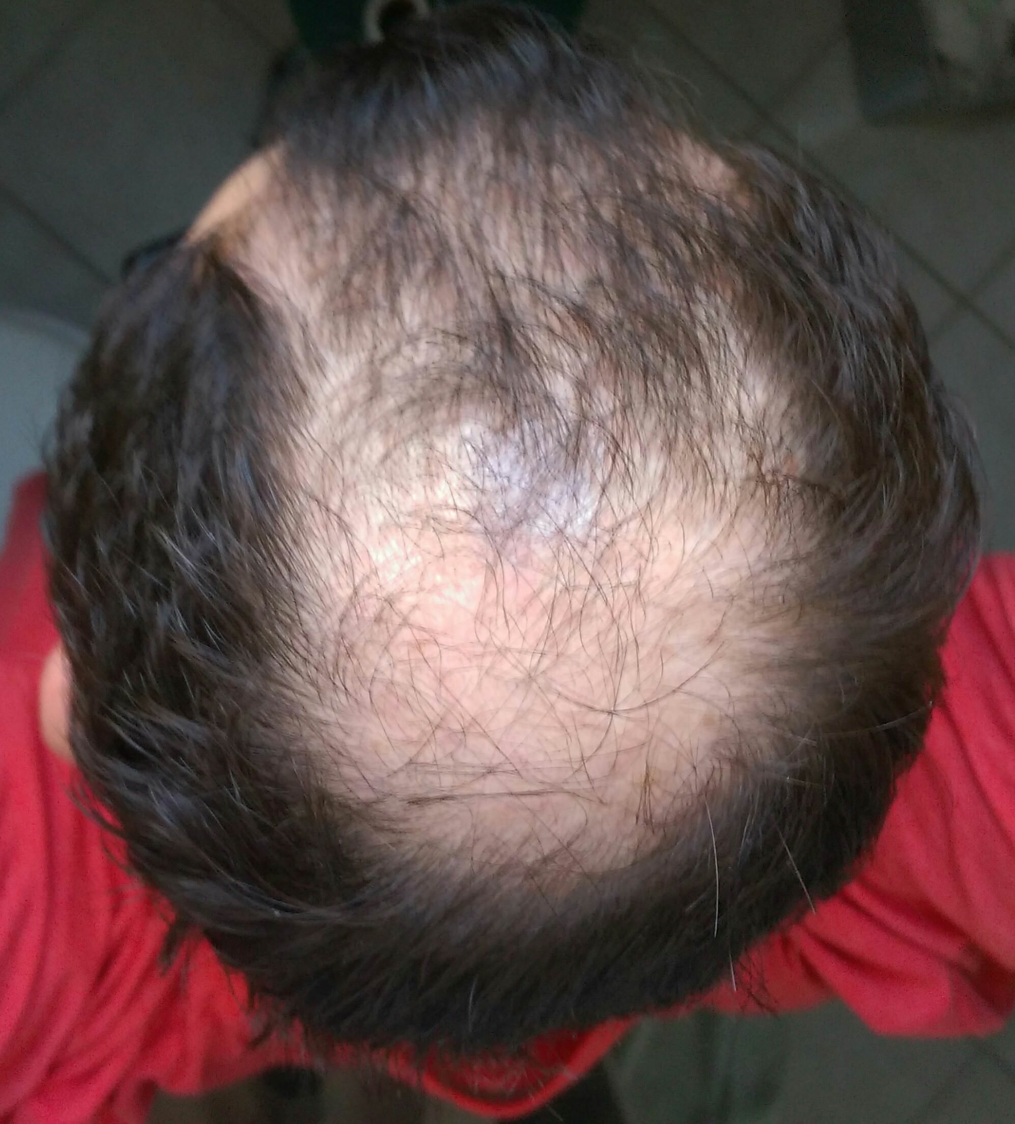 chute de cheveux homme