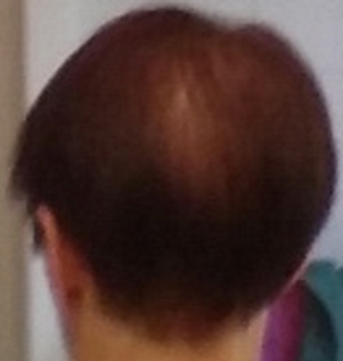Chute cheveux femme vertex