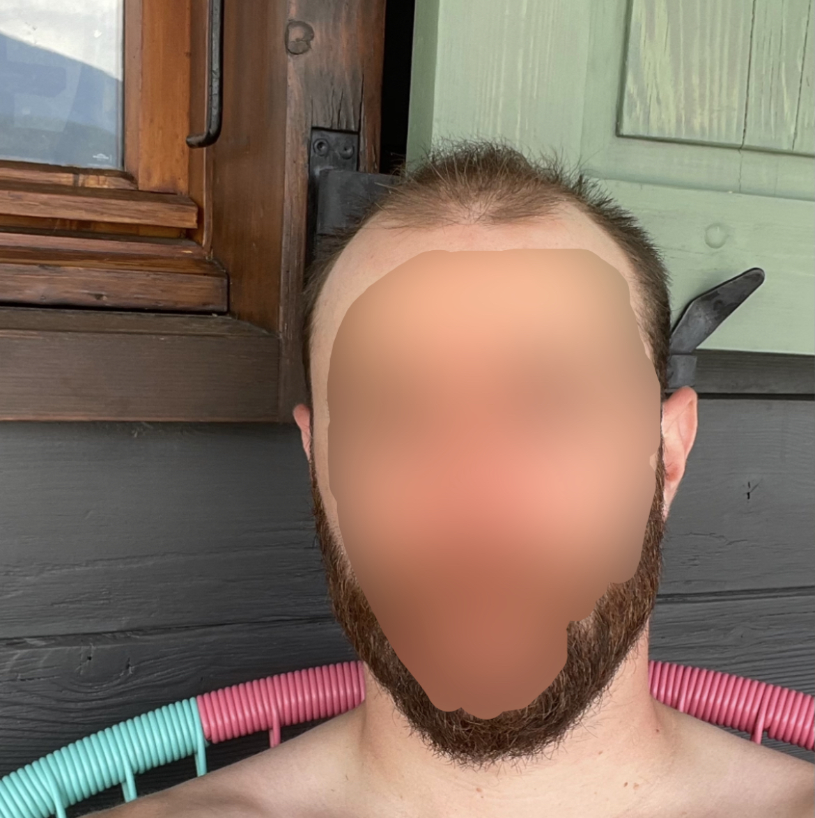 Homme chauve avant complément capillaire