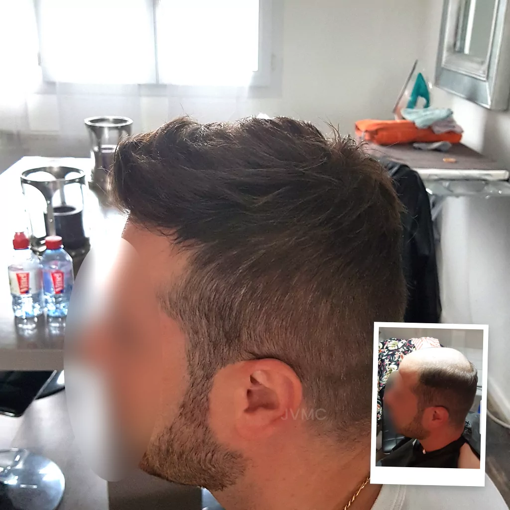 YC, membre du forum depuis 2019 — résultat naturel avec un complément capillaire homme